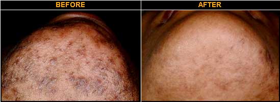 Before and After Photo of Patient being treated for Ingrown Hairs with Ultimate Light