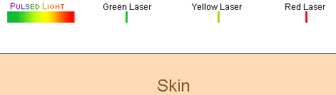 diagram showing difference between pulsed light and laser lights on skin