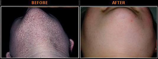 PCOS Unwanted Hair Before and After Photo