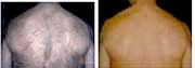Back Hair Removal