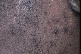 Sideburn - After