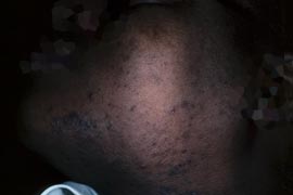 12/99 DARK SKIN - After