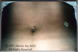 abdomen of a 19 year old female - After