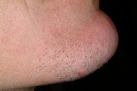 right chin - before