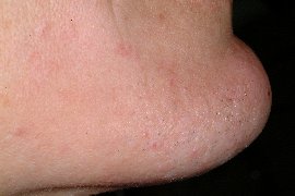 right chin - after