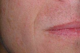 right upperlip - Before