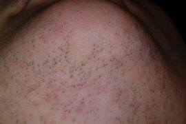showing decreased hairs - Before