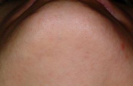 showing decreased hairs - After
