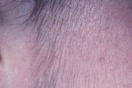 Sideburn of 35 yr old female - Before