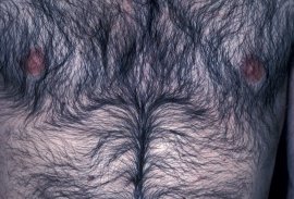 35 year old male chest - Before