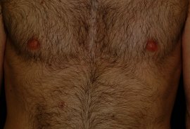 35 year old male chest - After