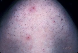Chin of 30 year old female - Before
