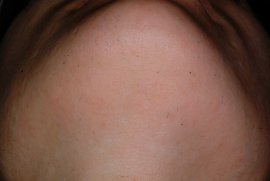 Chin of 30 year old female - After