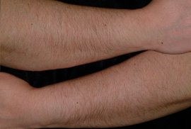 Forearms of female - Before