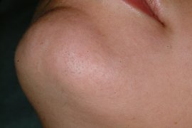 Chin of 25 year old female - After