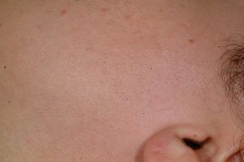 Left sideburn of 25 year old female - After