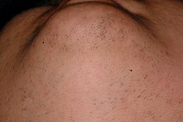 Polycystic Ovarian Syndrome Under Chin - Before