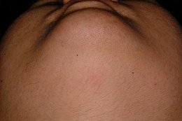 Polycystic Ovarian Syndrome Under Chin - After