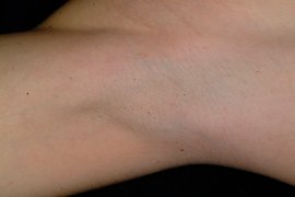 Underarm of 30 year old female - After