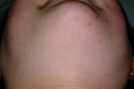 Polycystic Ovarian Syndrome - After