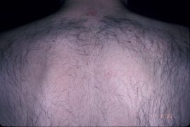 ONLY 1 TREATMENT - Before