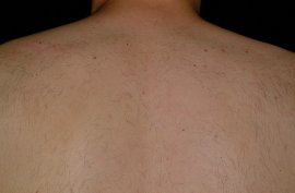 ONLY 1 TREATMENT - After