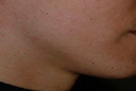 Male Facial Hair Removal Side - After