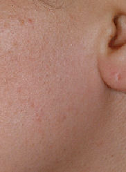 Left Sideburn - After