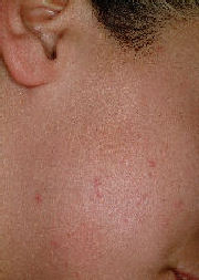 Right Sideburn - After