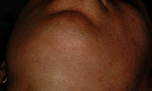 Skin type 6 female chin - After