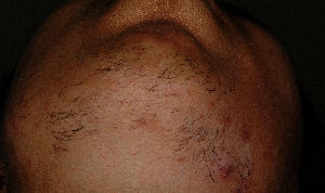 Skin type 6 female chin - Before
