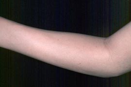 Sixteen Year Old Female - After