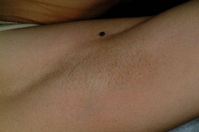 Armpit Skin Type 4 - After