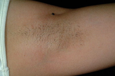 Armpit Skin Type 4 - Before
