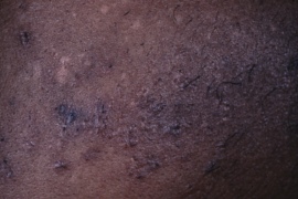 eft cheek of a female patient - After