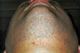 clearing of ingrown hairs under Chin - After