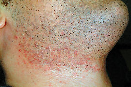 clearing of ingrown hairs on neck - Before