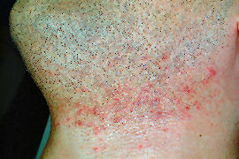 clearing of ingrown hairs on rear neck - Before