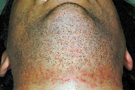 clearing of ingrown hairs under Chin - Before