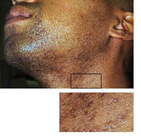 Decreased Pimples and Ingrown Hairs-Chin and Neck - After