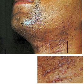 Ingrown Hairs-Chin and Neck - Before