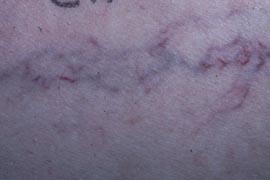 Close up of blood vessels - Before