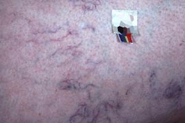 blood vessel removal - Before