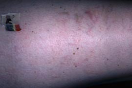 leg veins on her right anterior thigh - After