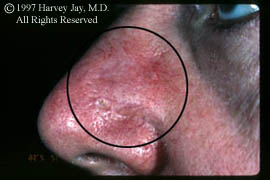 Treatment of Rhinophyma - Before