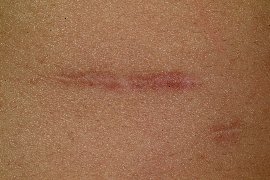 dark scar lightened - After