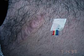 Stretch Marks - After