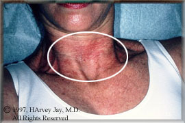 sun damage of neck and chest- before