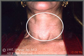sun damage of neck and chest- After