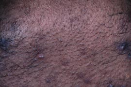 DARK SKIN - Before
